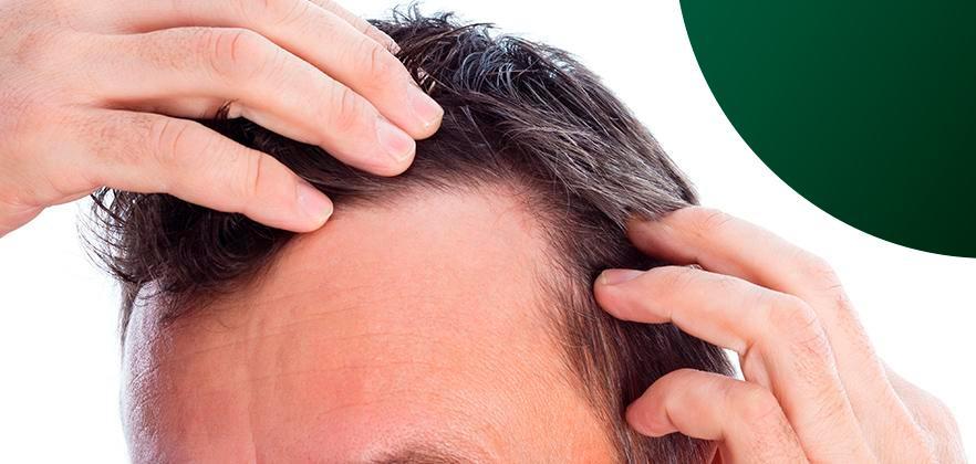 Cabelo caindo em excesso? Conheça 15 causas! - Capellux