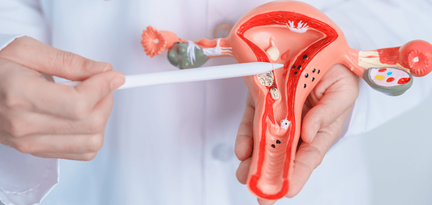 Endometriose - o que causa no corpo?